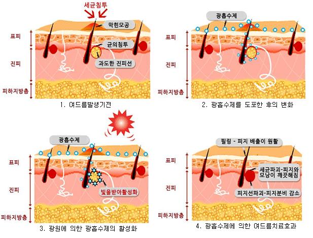 PDT 치료순서.JPG