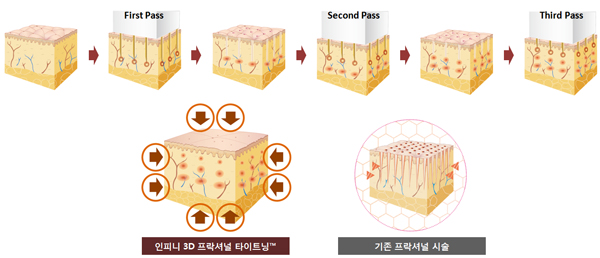 인피니-3D프락셔널-타이트닝.jpg