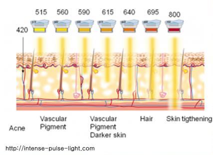 펄피부과_IPL 다양한파장.JPG