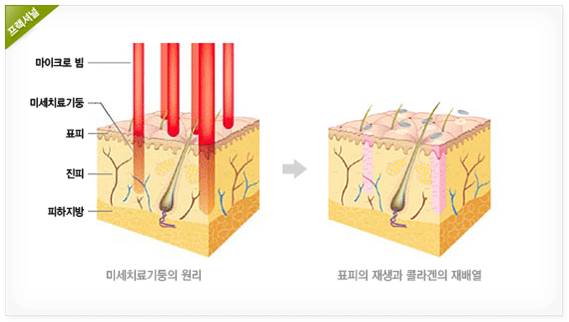 프락셀레이저치료의 원리.jpg